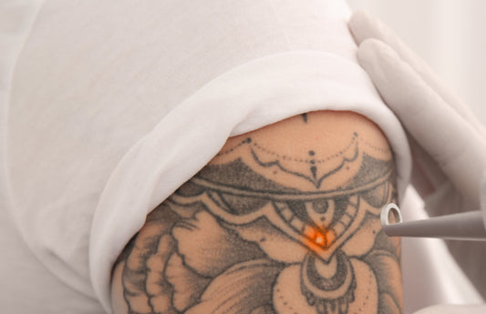 Image of tattoo removal laser