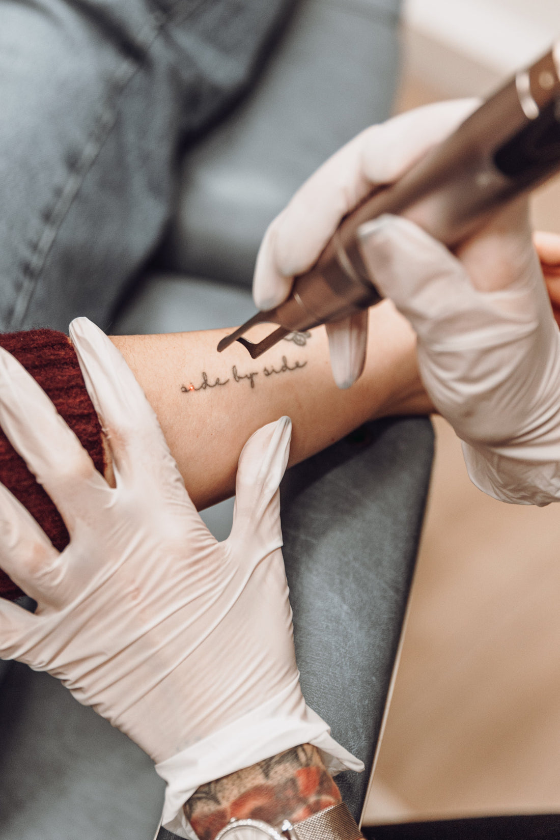 When Tattoo Removal Doesn’t Blister: Why Calm Skin Is Actually a Good Sign